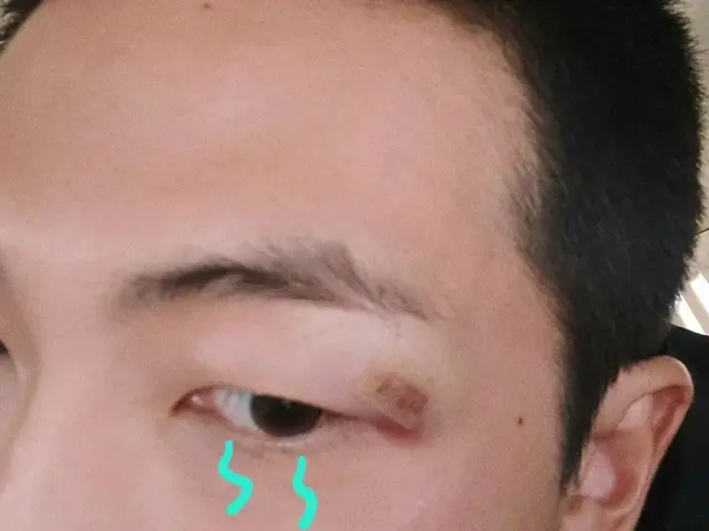 RM的粉絲在露出眉毛下的傷疤後很擔心