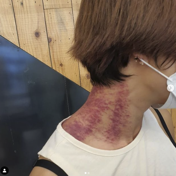 與德國丈夫結婚的喜劇演員金海成（Kim Hae-sung）脖子上有深藍色的瘀傷...您被打過嗎？